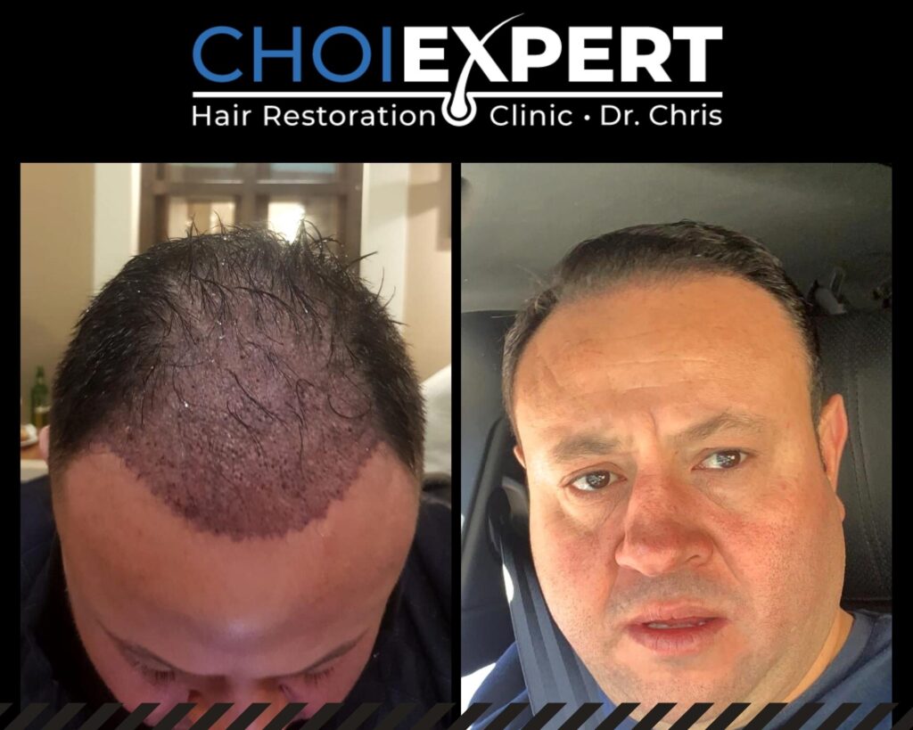 Before & After - Hair Transplantation Experts