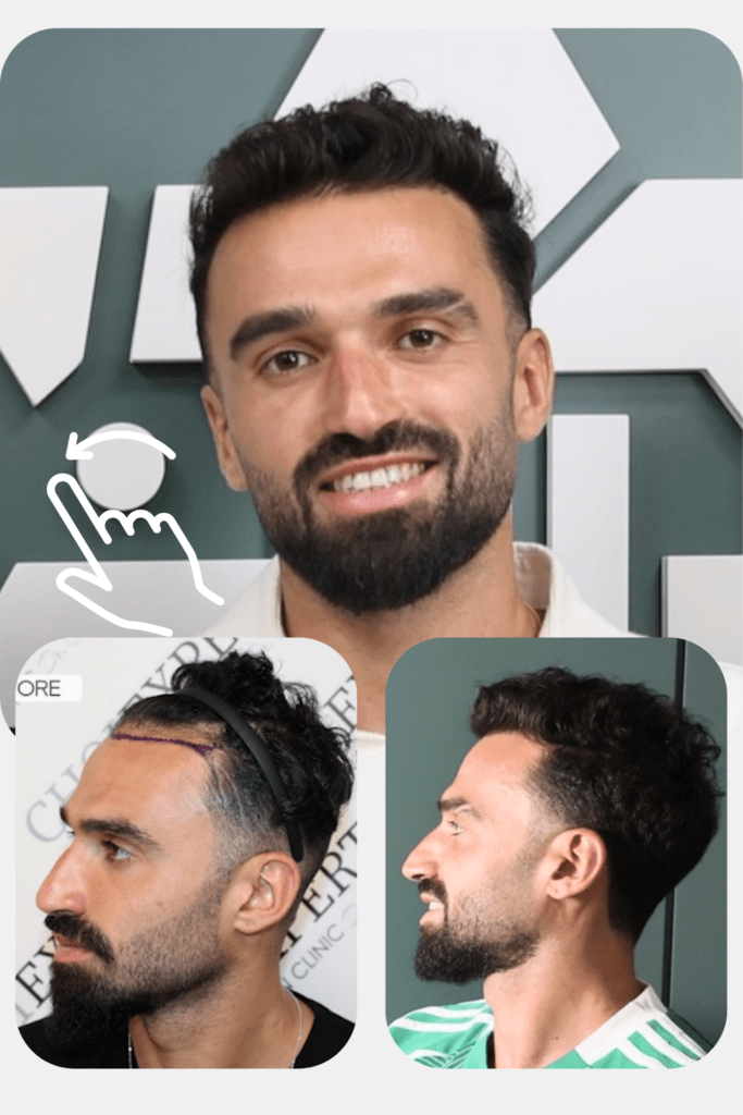 Michael ohana hair trensplant